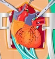 Heart Surgery Simulation